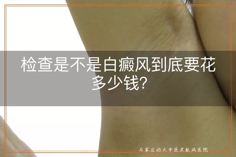 检查是不是白癜风到底要花多少钱？