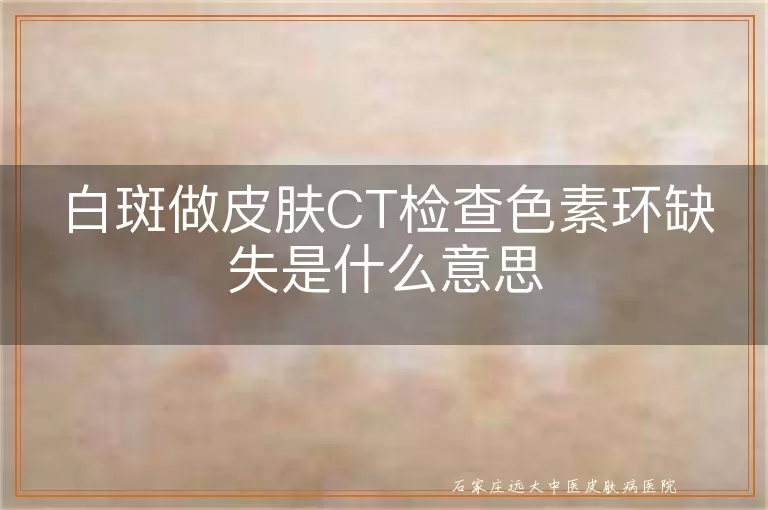 白斑做皮肤CT检查色素环缺失是什么意思