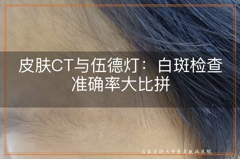 皮肤CT与伍德灯：白斑检查准确率大比拼