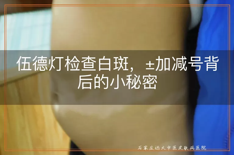 伍德灯检查白斑，±加减号背后的小秘密