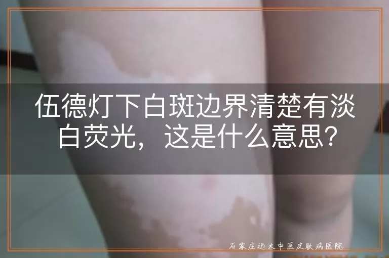 伍德灯下白斑边界清楚有淡白荧光，这是什么意思？