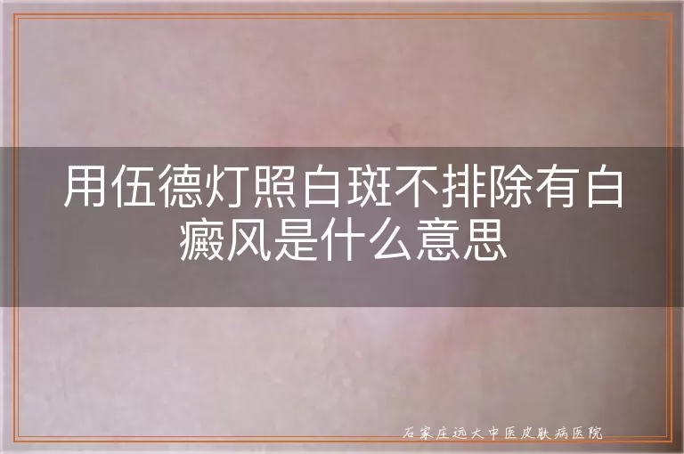 用伍德灯照白斑不排除有白癜风是什么意思