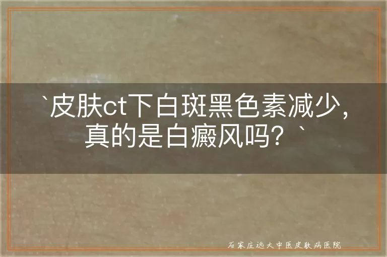 皮肤ct下白斑黑色素减少，真的是白癜风吗？