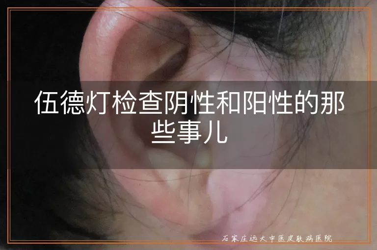 伍德灯检查阴性和阳性的那些事儿