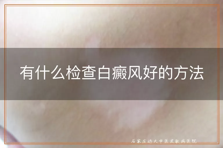 有什么检查白癜风好的方法