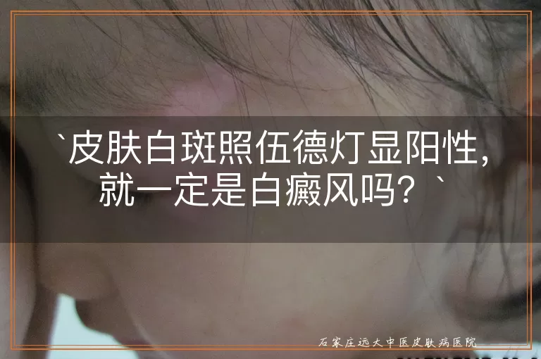 皮肤白斑照伍德灯显阳性，就一定是白癜风吗？