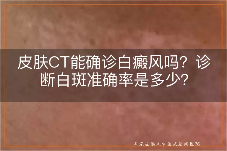 皮肤CT能确诊白癜风吗？诊断白斑准确率是多少？