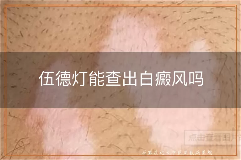 伍德灯能查出白癜风吗