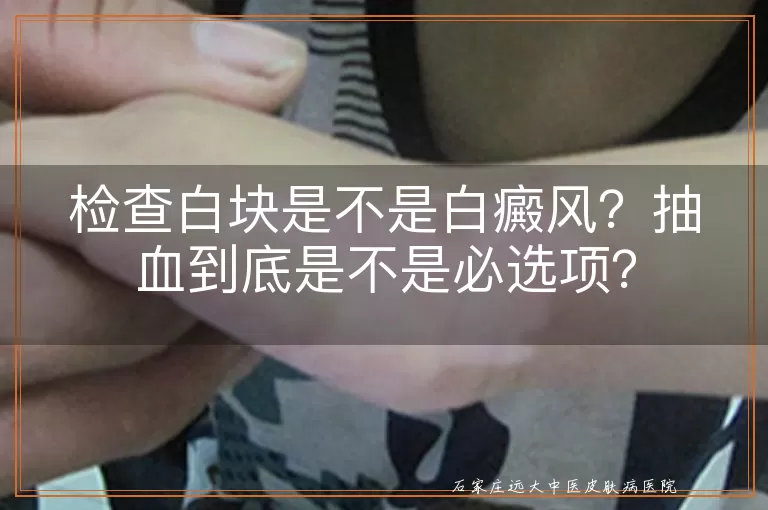 检查白块是不是白癜风？抽血到底是不是必选项？