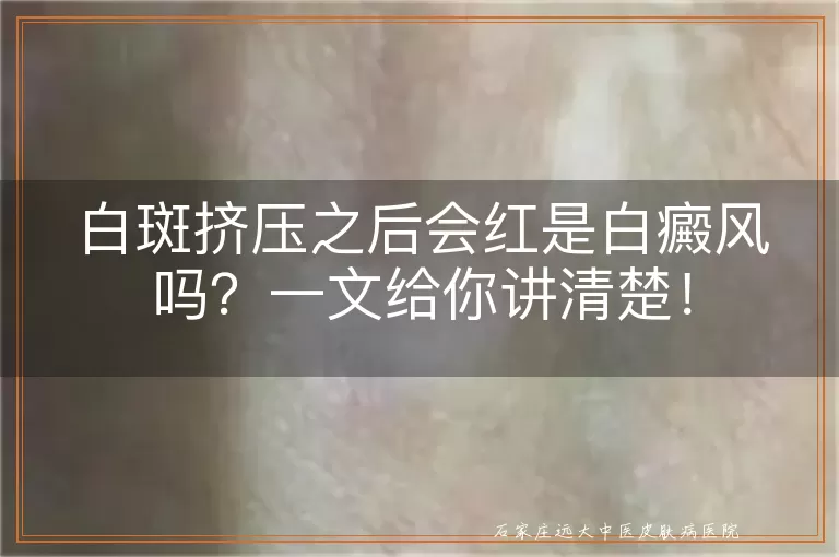 白斑挤压之后会红是白癜风吗？一文给你讲清楚！