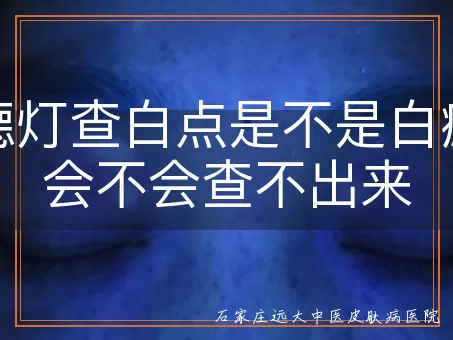 伍德灯查白点是不是白癜风会不会查不出来
