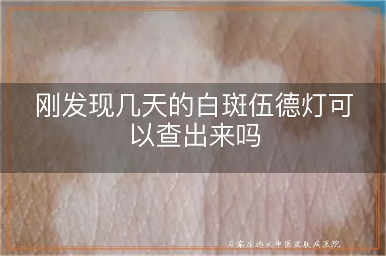 刚发现几天的白斑伍德灯可以查出来吗