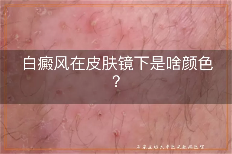 白癜风在皮肤镜下是啥颜色？