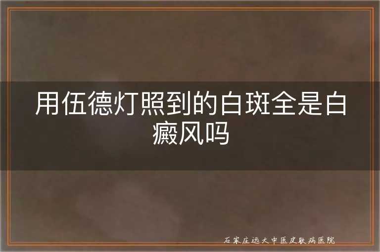 用伍德灯照到的白斑全是白癜风吗