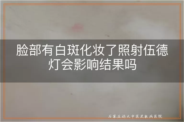 脸部有白斑化妆了照射伍德灯会影响结果吗