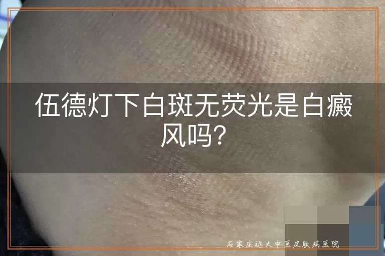 伍德灯下白斑无荧光是白癜风吗？