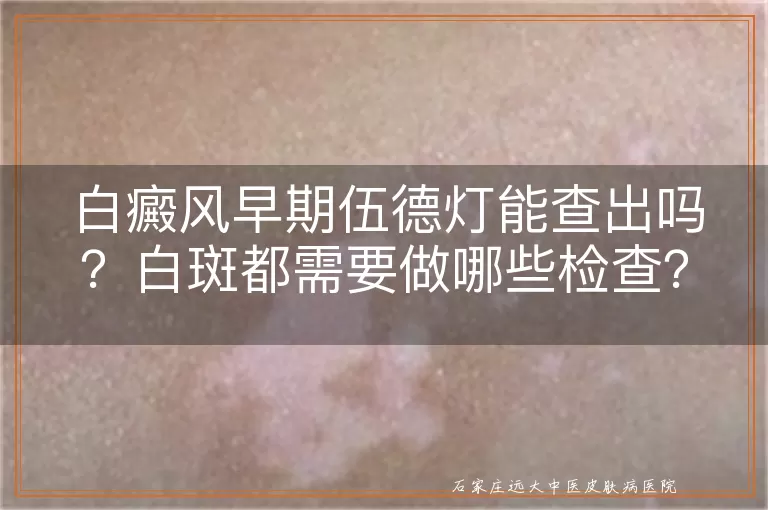 白癜风早期伍德灯能查出吗？白斑都需要做哪些检查？