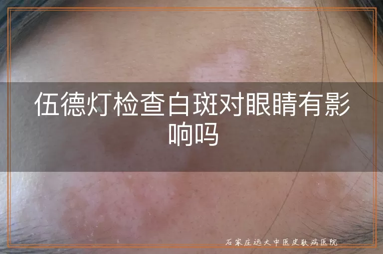 伍德灯检查白斑对眼睛有影响吗