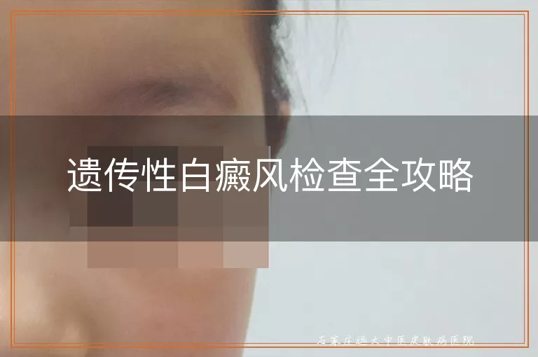 遗传性白癜风检查全攻略