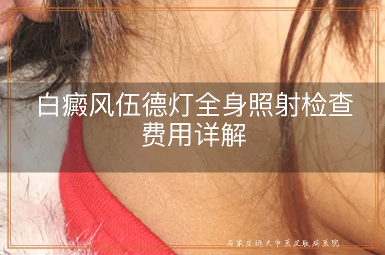 白癜风伍德灯全身照射检查费用详解