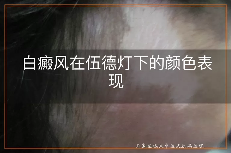 白癜风在伍德灯下的颜色表现
