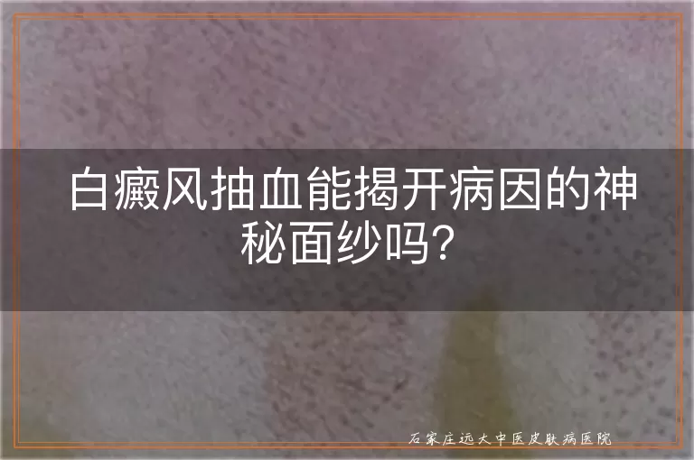 白癜风抽血能揭开病因的神秘面纱吗？
