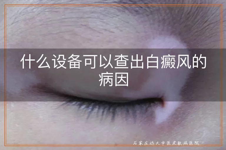 什么设备可以查出白癜风的病因