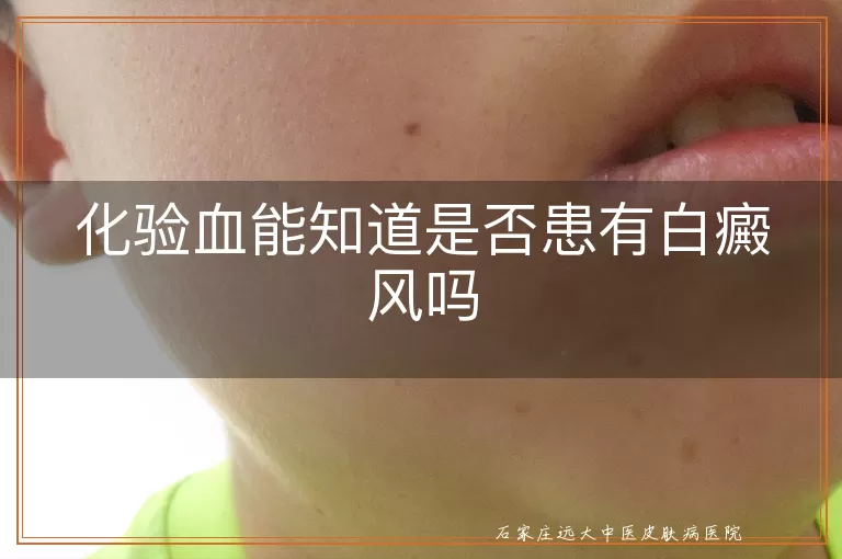 化验血能知道是否患有白癜风吗
