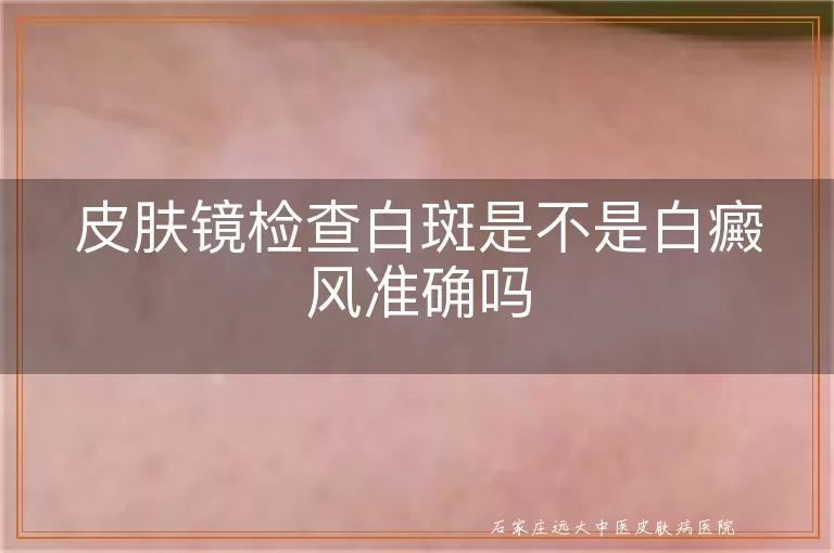 皮肤镜检查白斑是不是白癜风准确吗