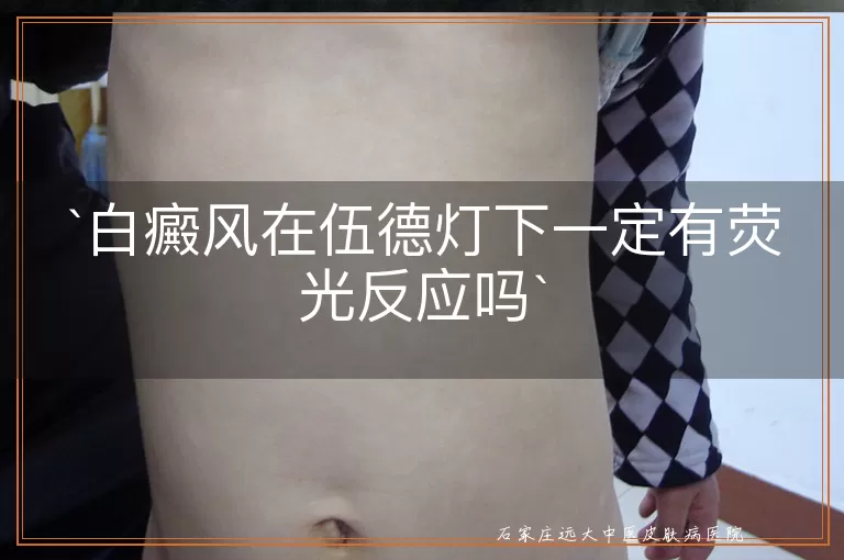 白癜风在伍德灯下一定有荧光反应吗