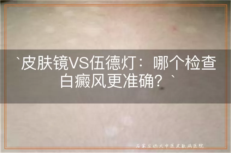 皮肤镜VS伍德灯：哪个检查白癜风更准确？
