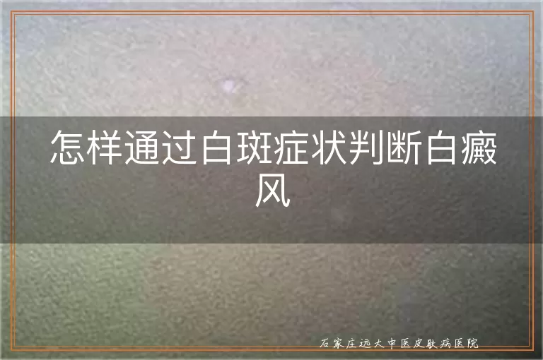 怎样通过白斑症状判断白癜风