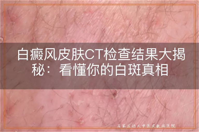 白癜风皮肤CT检查结果大揭秘：看懂你的白斑真相