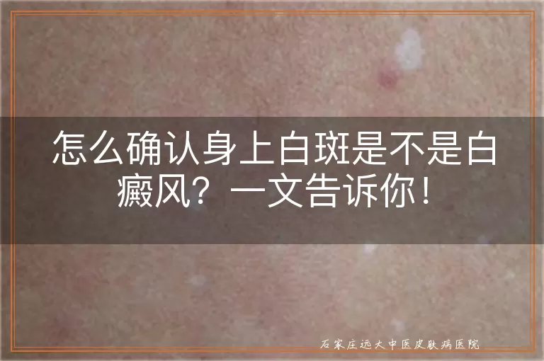 怎么确认身上白斑是不是白癜风？一文告诉你！