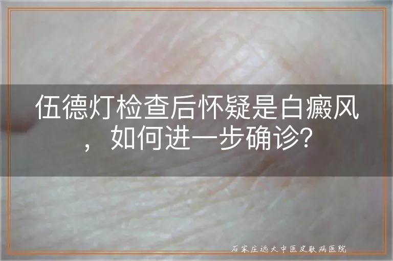 伍德灯检查后怀疑是白癜风，如何进一步确诊？