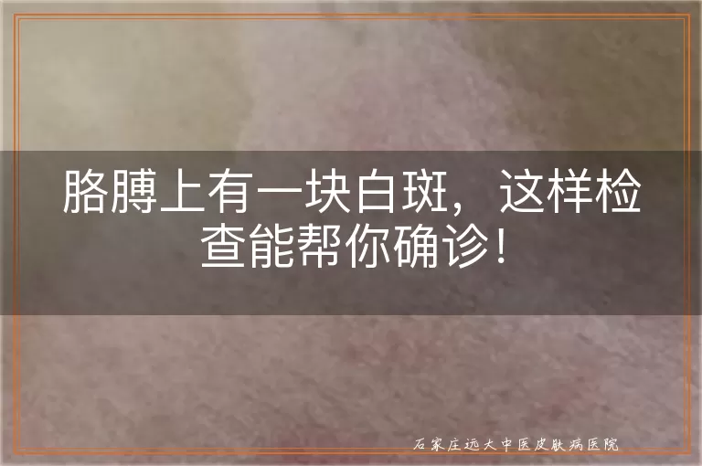 胳膊上有一块白斑，这样检查能帮你确诊！