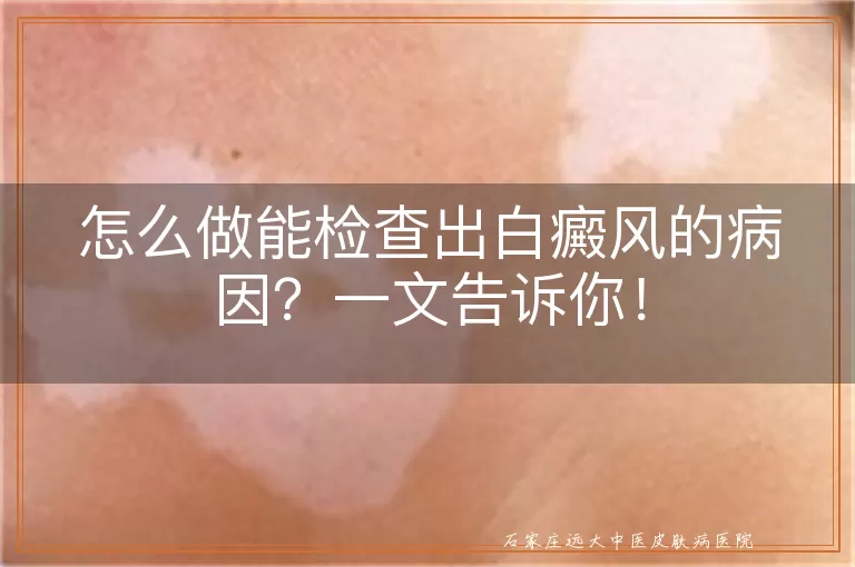 怎么做能检查出白癜风的病因？一文告诉你！
