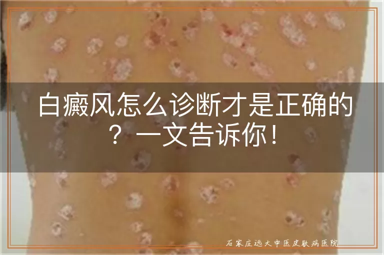 白癜风怎么诊断才是正确的？一文告诉你！