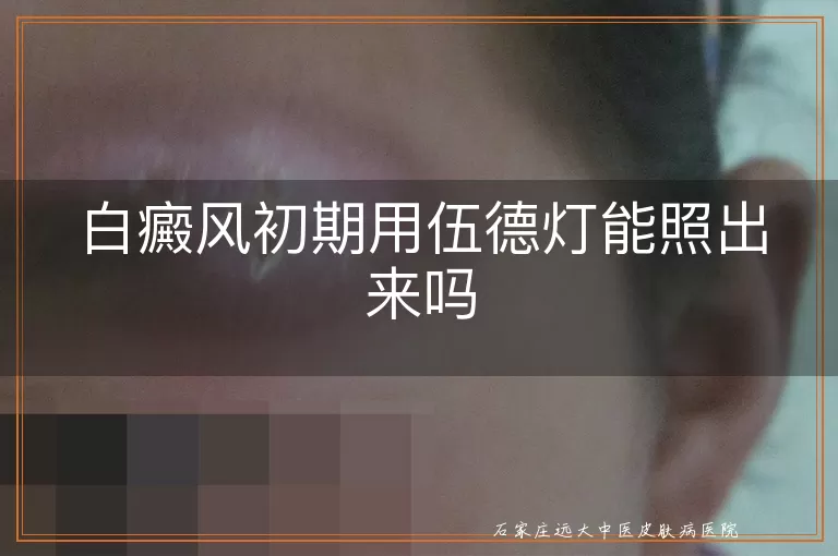 白癜风初期用伍德灯能照出来吗