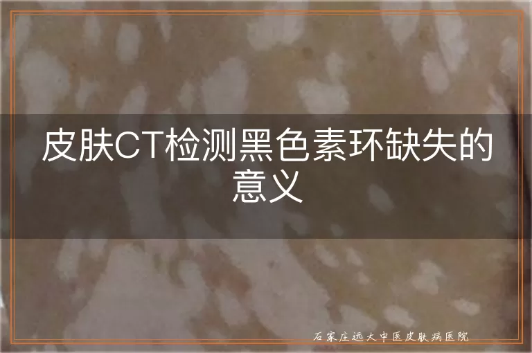 皮肤CT检测黑色素环缺失的意义