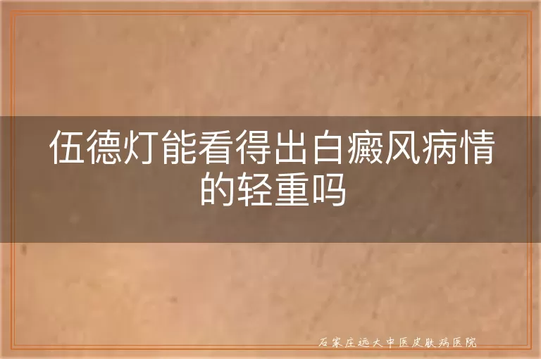 伍德灯能看得出白癜风病情的轻重吗