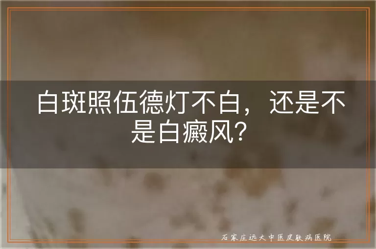 白斑照伍德灯不白，还是不是白癜风？