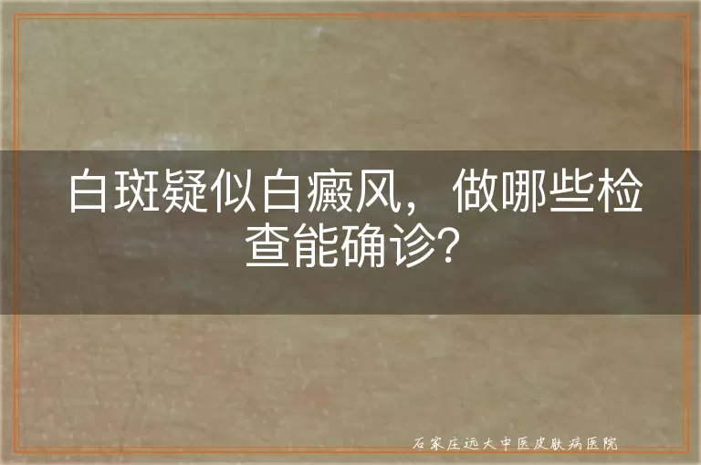 白斑疑似白癜风，做哪些检查能确诊？