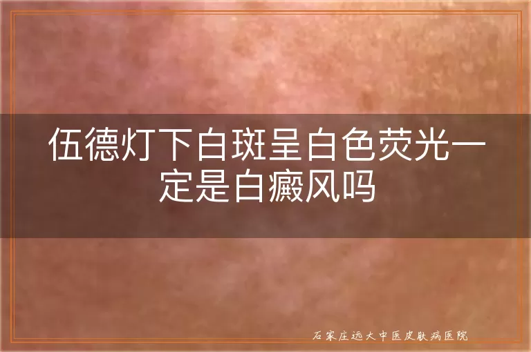伍德灯下白斑呈白色荧光一定是白癜风吗