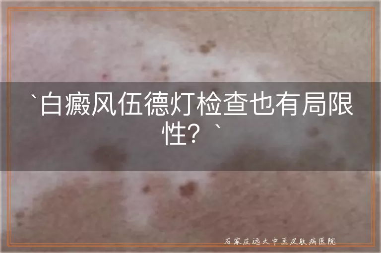 白癜风伍德灯检查也有局限性？