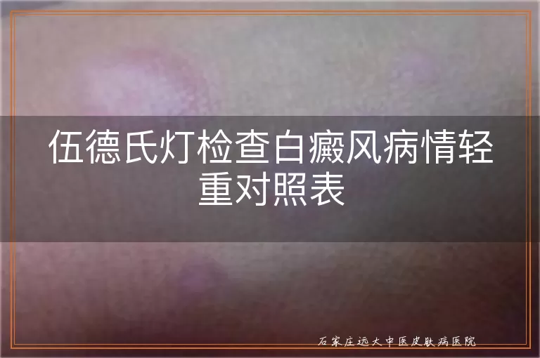 伍德氏灯检查白癜风病情轻重对照表