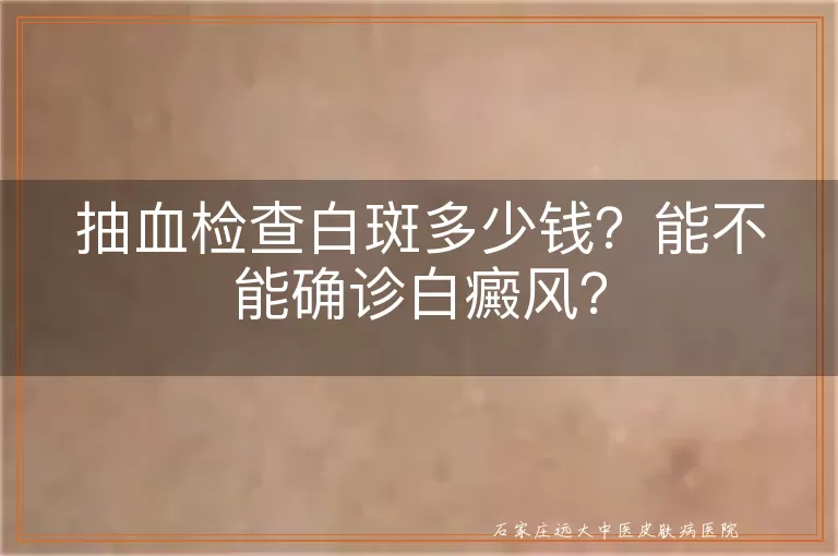 抽血检查白斑多少钱？能不能确诊白癜风？