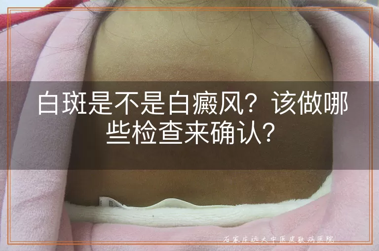 白斑是不是白癜风？该做哪些检查来确认？
