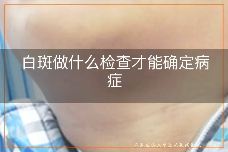 白斑做什么检查才能确定病症