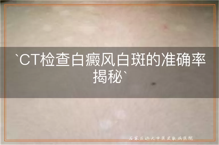CT检查白癜风白斑的准确率揭秘